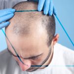 Injerto de cabello cuánto cuesta