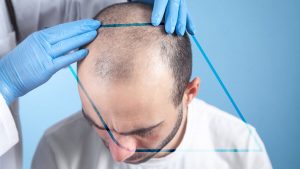 Injerto de cabello