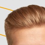 Injerto de cabello sintético, ¿cómo funciona?
