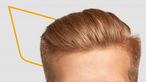 Injerto de cabello
