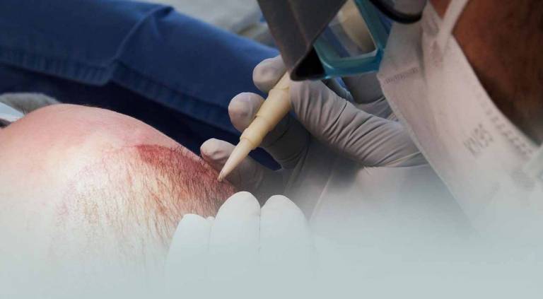 hair transplant dallas cost