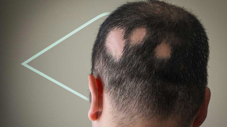 Tratamiento para la alopecia areata