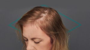 Alopecia en mujeres