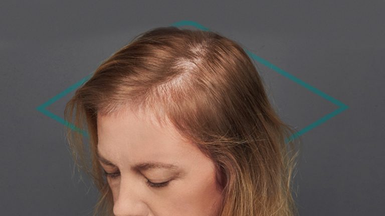 ¿Cómo es la alopecia difusa en mujeres?