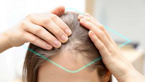 Alopecia femenina por estrés