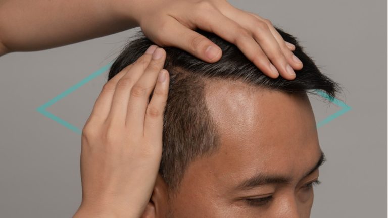 tipos de alopecia en hombres