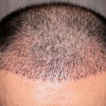 injerto capilar a los 5 meses
