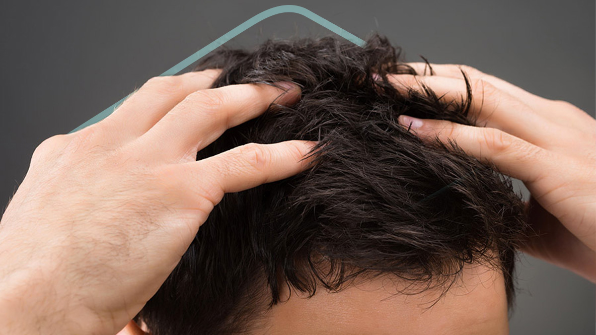 Minoxidil para la alopecia: 5 preguntas - Kaloni México ®