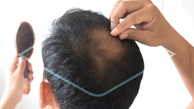 como combatir la alopecia
