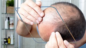 Alopecia androgenética