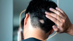 Síntomas de alopecia areata