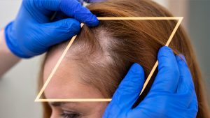 Alopecia en mujeres