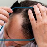 Trasplante de Cabello Infectado