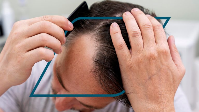 Trasplante de Cabello Infectado