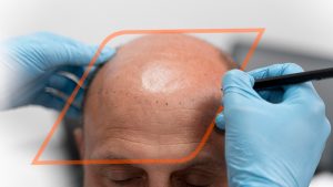 alopecia en hombres