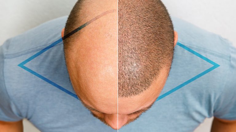 trasplante de Cabello