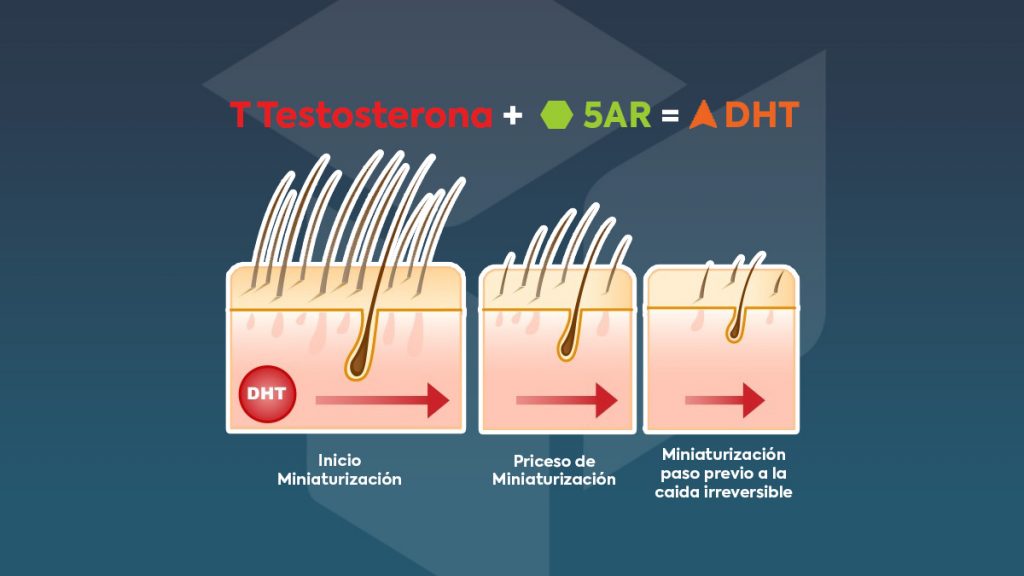 alopecia-androgenica-dht