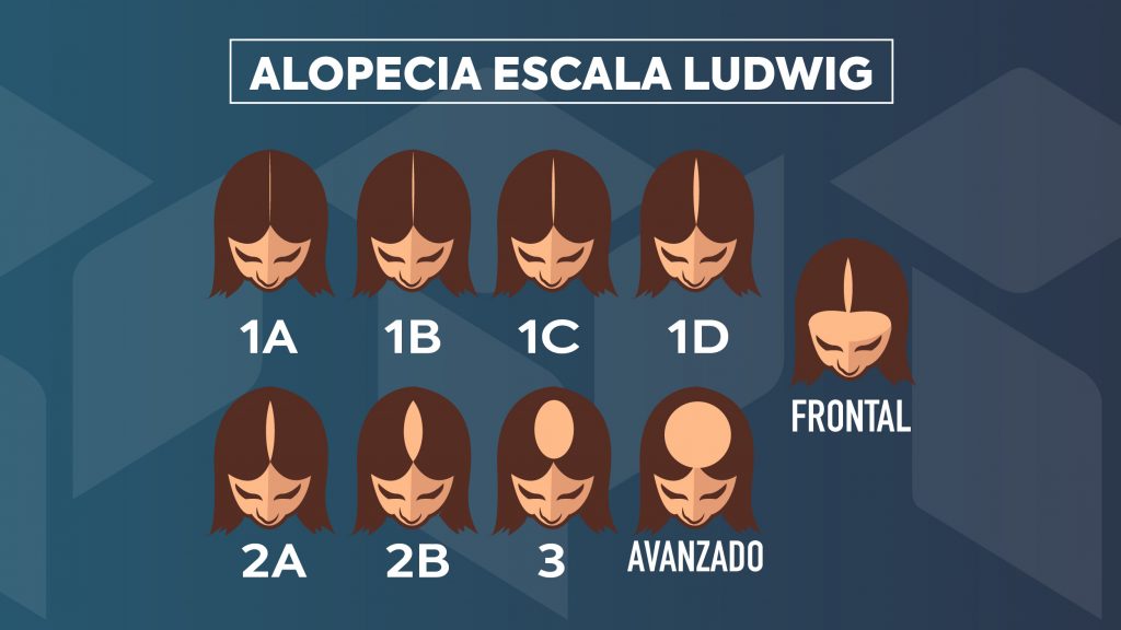 alopecia-androgenica-escala-ludwig