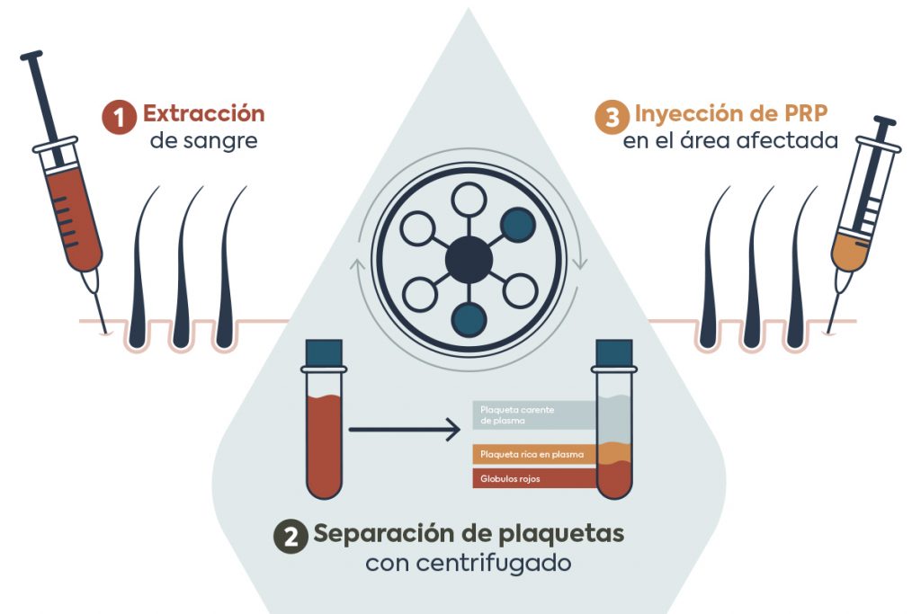 plasma-rico-en-plaquetas-kaloni