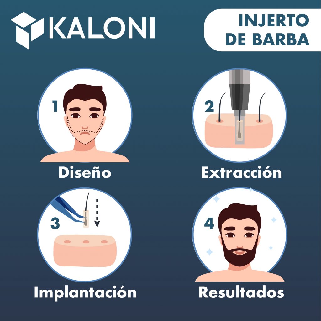 ilustracion-injerto-de-barba-paso-a-paso