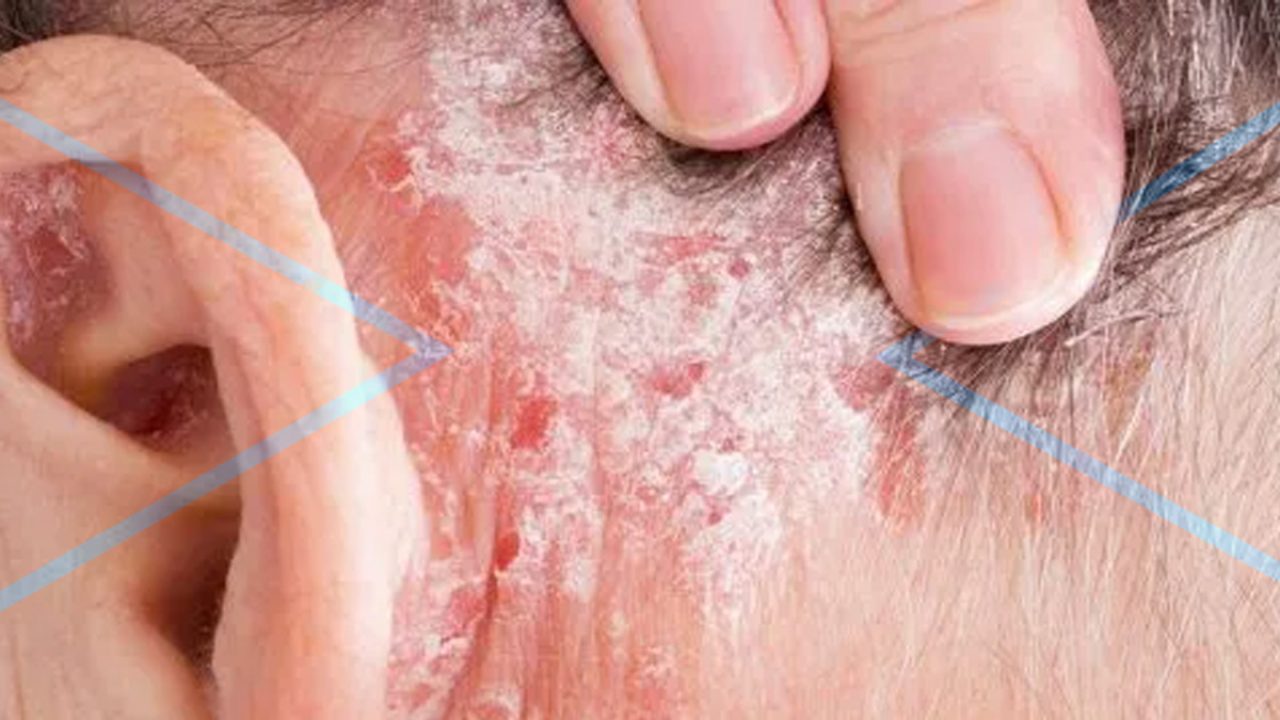 Dermatitis seborreica, una enfermedad que suele reaparecer - Noticias de El  Salvador