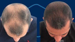 Implante de pelo antes y después