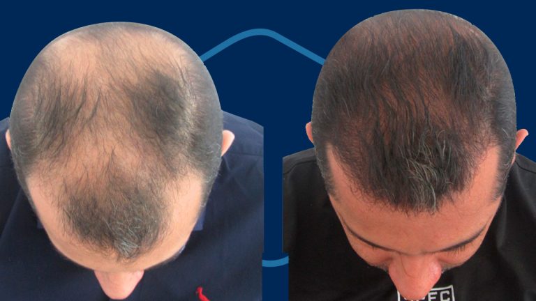 Implante de pelo antes y después