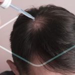 Minoxidil en Farmacias Similares