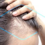 minoxidil