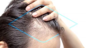 minoxidil