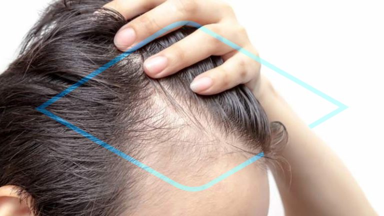minoxidil