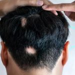 ¿Qué tan efectivo es el minoxidil para la alopecia areata?