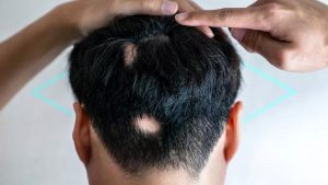 Alopecia areata