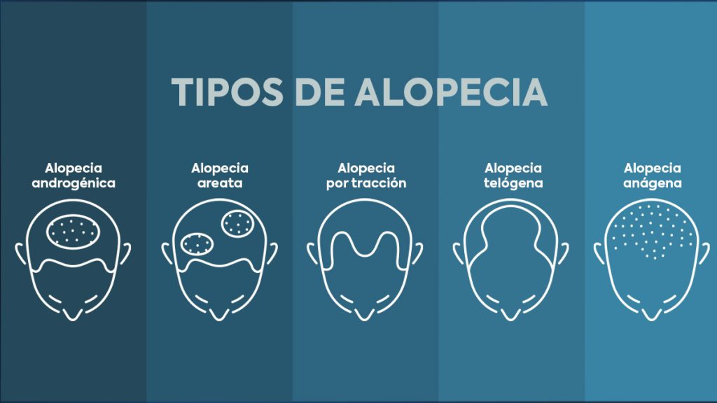 ¿La alopecia se cura?