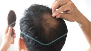 implante de cabello