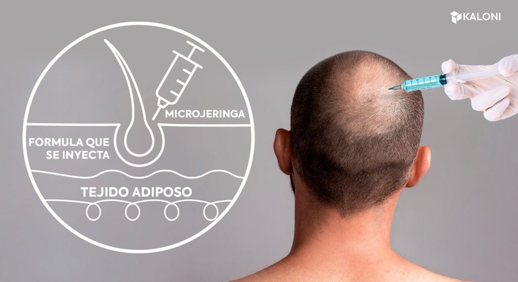 mesoterapia capilar