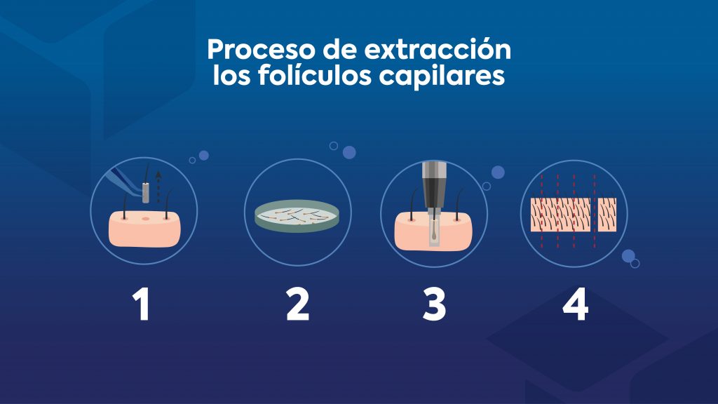 Infografía de proceso de extracción de folículos