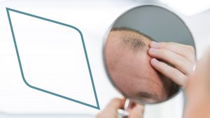 Alopecia en hombres