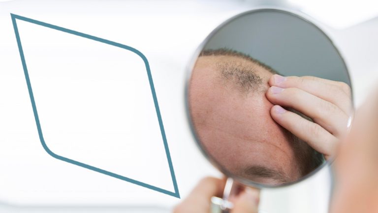 Alopecia en hombres