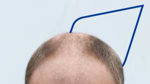 Alopecia masculina