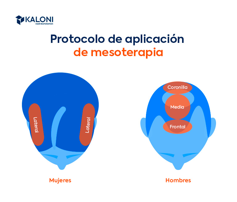 Protocolo de aplicación del tratamiento mesoterapia capilar