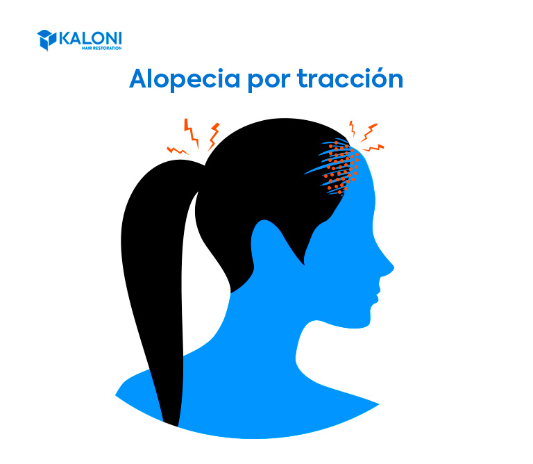 Alopecia por tracción