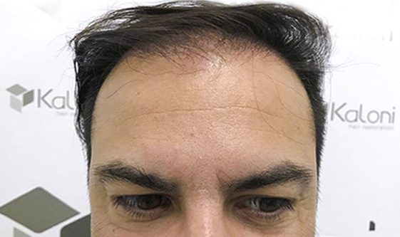 Antes-hair