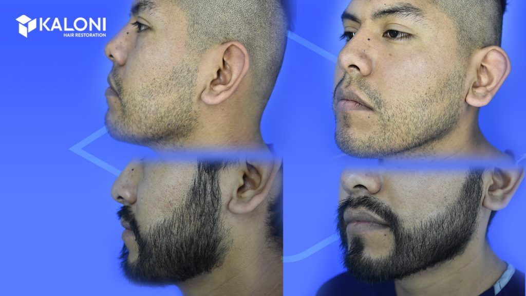 Injerto de barba antes y después