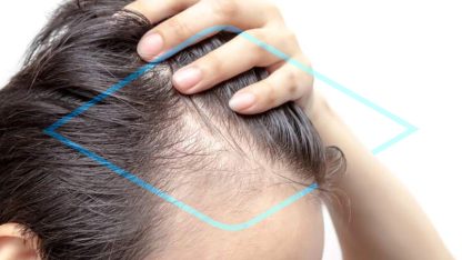 minoxidil