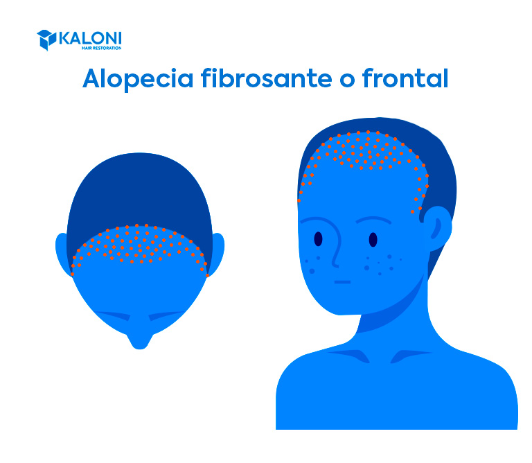 Alopecia fibrosante o frontal