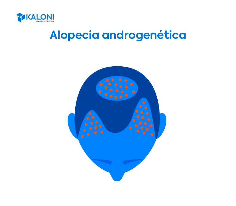 Alopecia androgenética