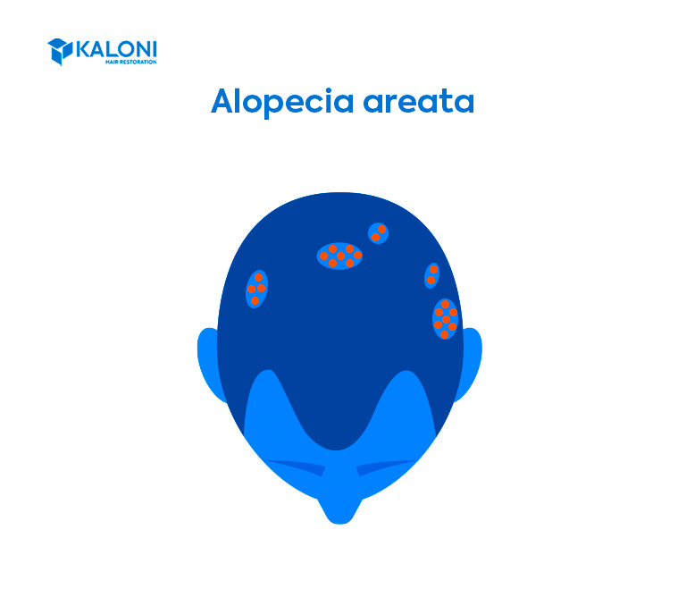 Alopecia areata