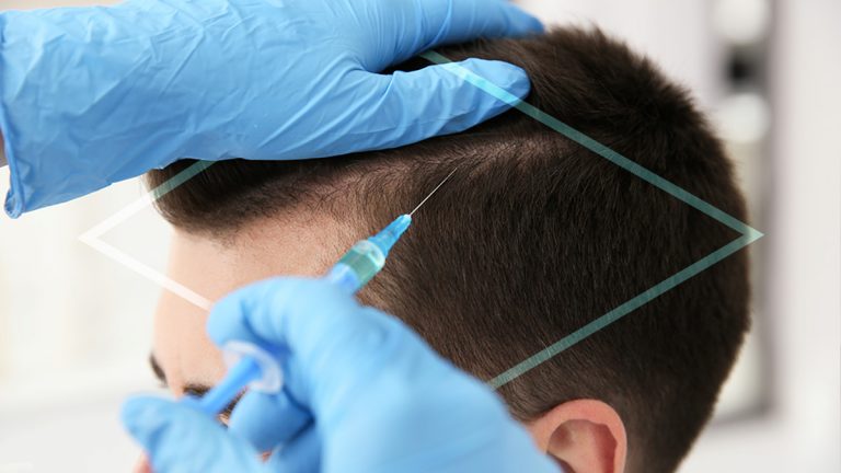 ¿Qué es la mesoterapia capilar hair recovery?