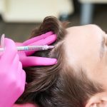 Minoxidil inyectable, ¿cómo es?